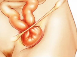 Emotional healing of hernias (inguinal hernia)